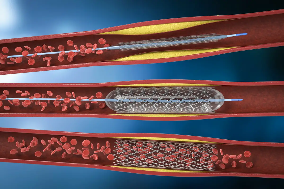 Angiography & Angioplasty Boduppal