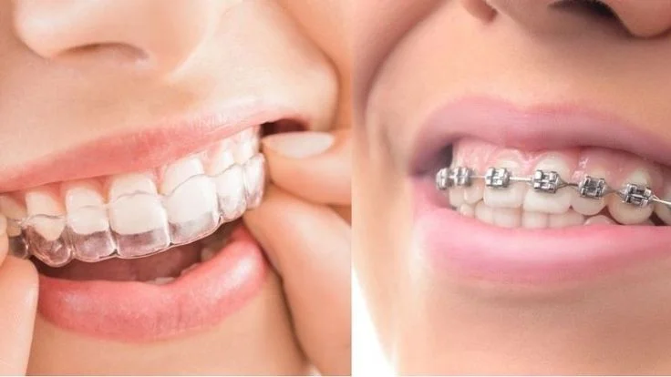 Braces & Aligners Boduppal