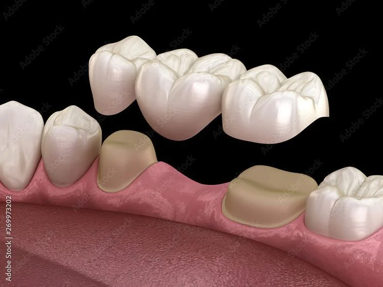 Crowns, Bridges & Dentures Boduppal