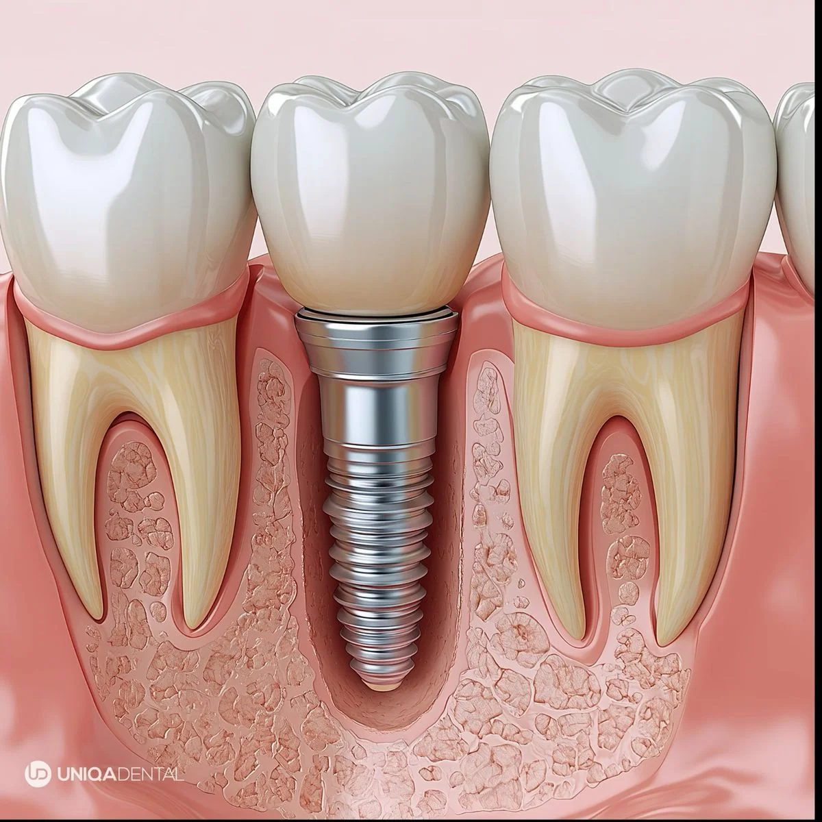 Dental Implants Boduppal
