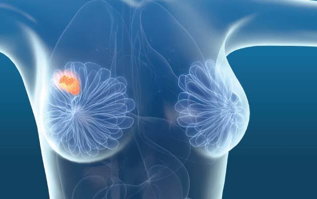 Breast Lump Surgery Boduppal