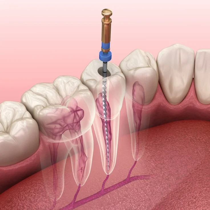 Root Canal Treatment (RCT) Boduppal