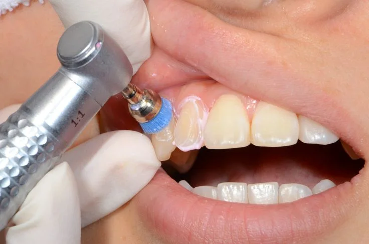 Scaling & Gum Treatment Boduppal
