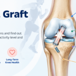 Which ACL Graft Is Better